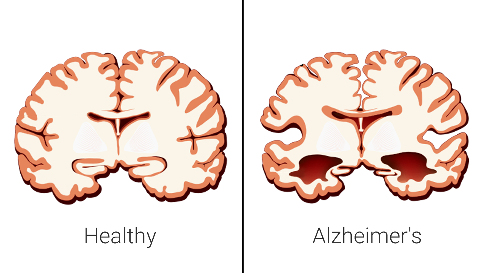 Alzheimer - jak zmienia się mózg chorego