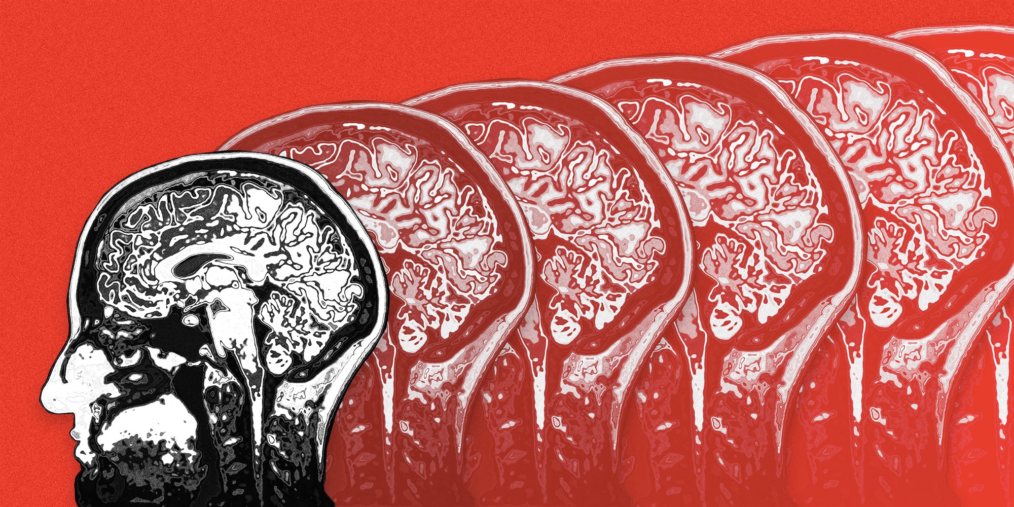 Plastyczność mózgu w terapii neuropsychologicznej